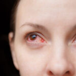 Eye Emergencies