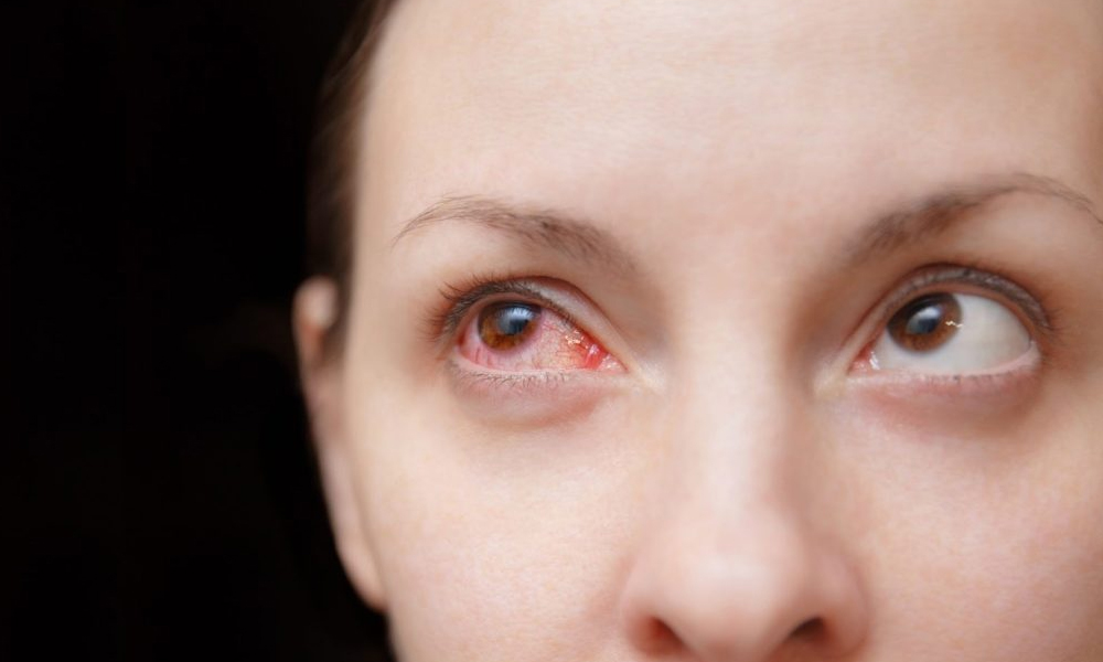 Eye Emergencies