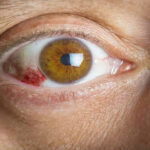 Eye Infection