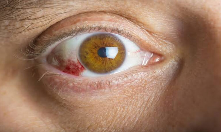 Eye Infection