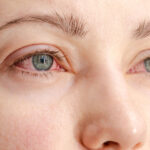 Dry Eye Affect Vision