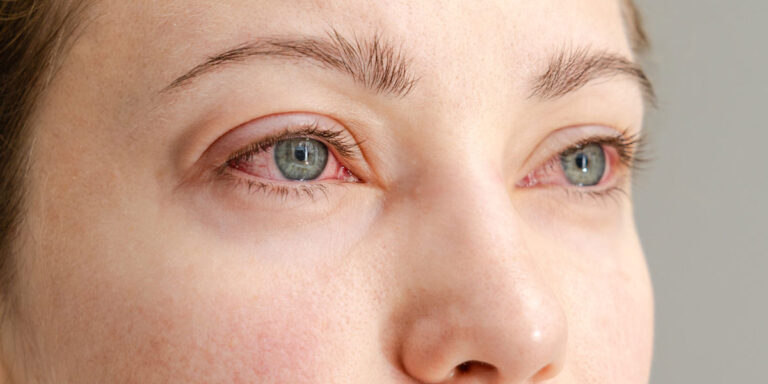 Dry Eye Affect Vision