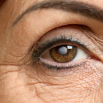First Signs of Cataracts