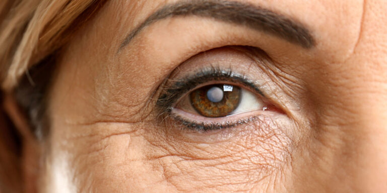 First Signs of Cataracts