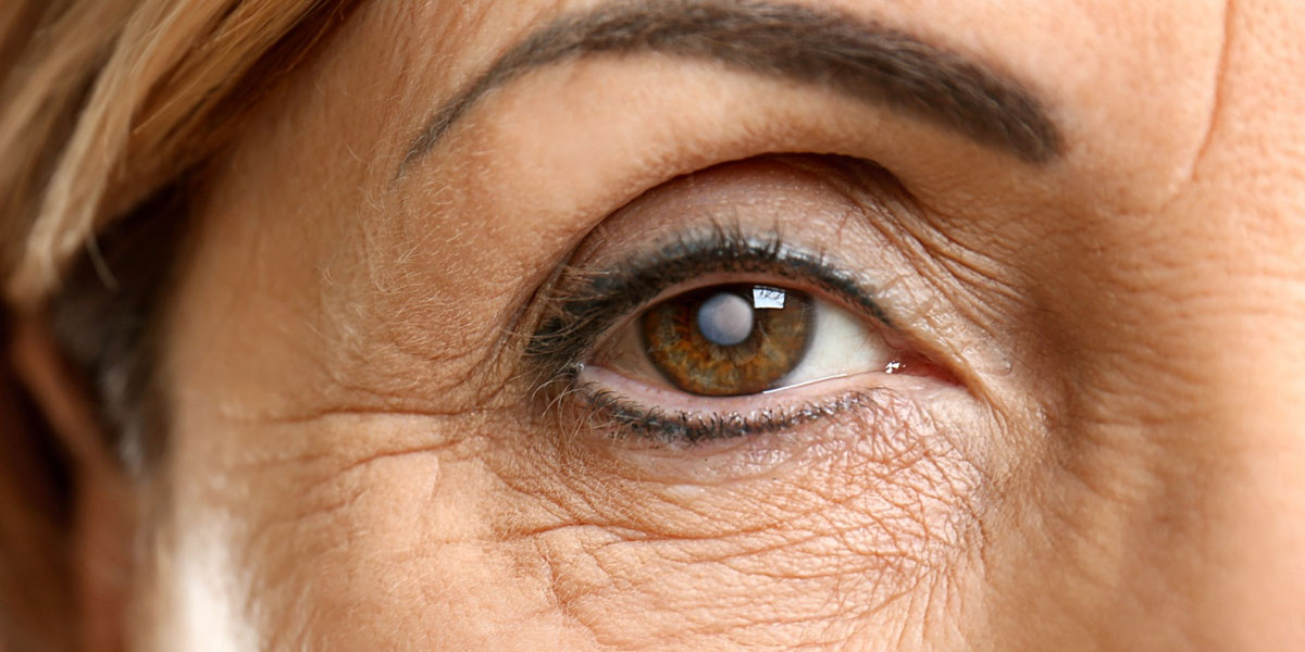 First Signs of Cataracts