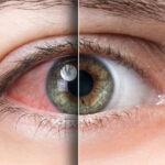 best contact lenses for dry eyes