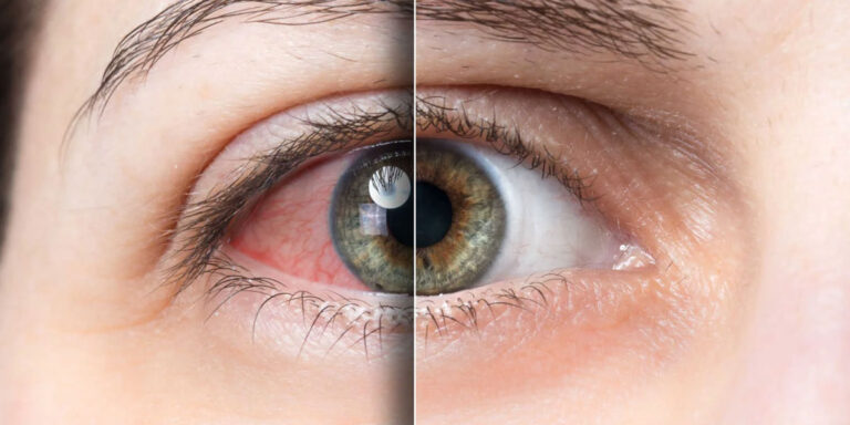 best contact lenses for dry eyes