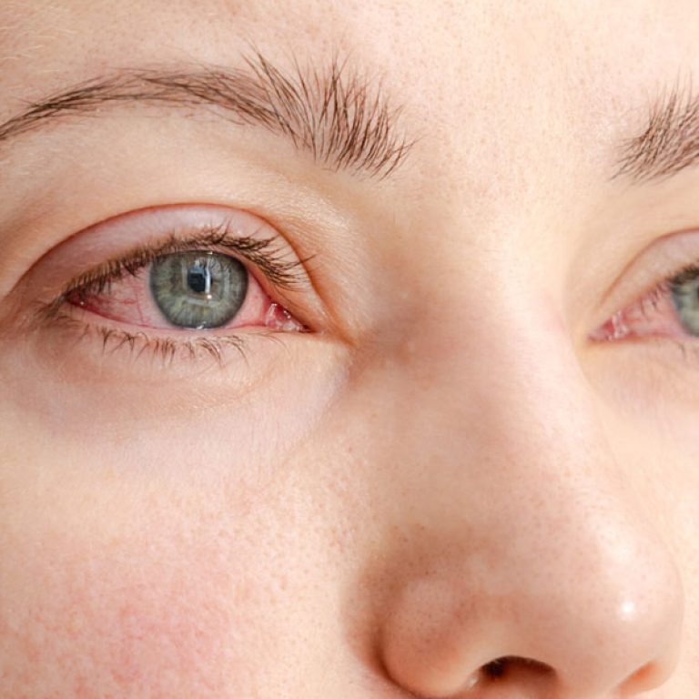 Dry Eye Affect Vision