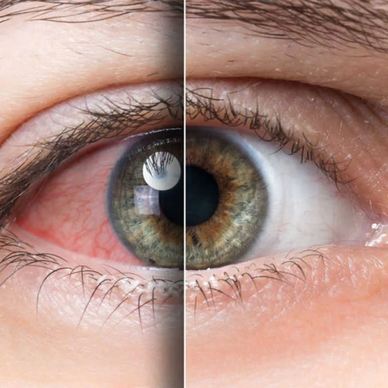 best contact lenses for dry eyes