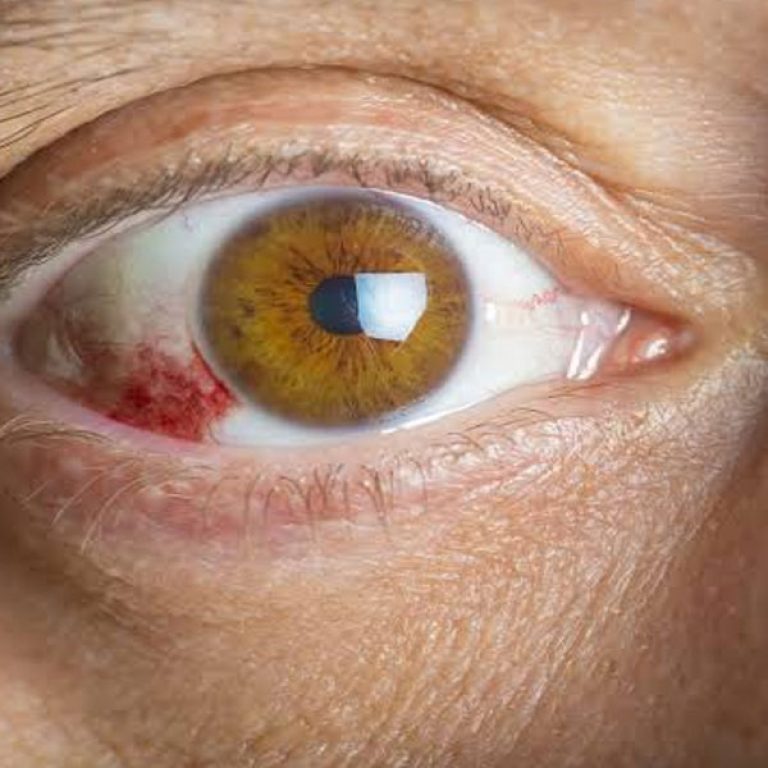Eye Infection